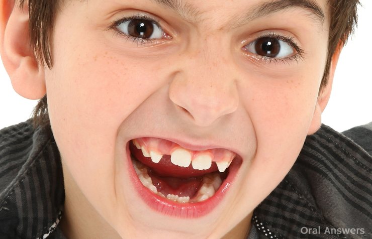 बच्चों के टेड़े मेढे दांत इस तरह ठीक करें crooked teeth remedy